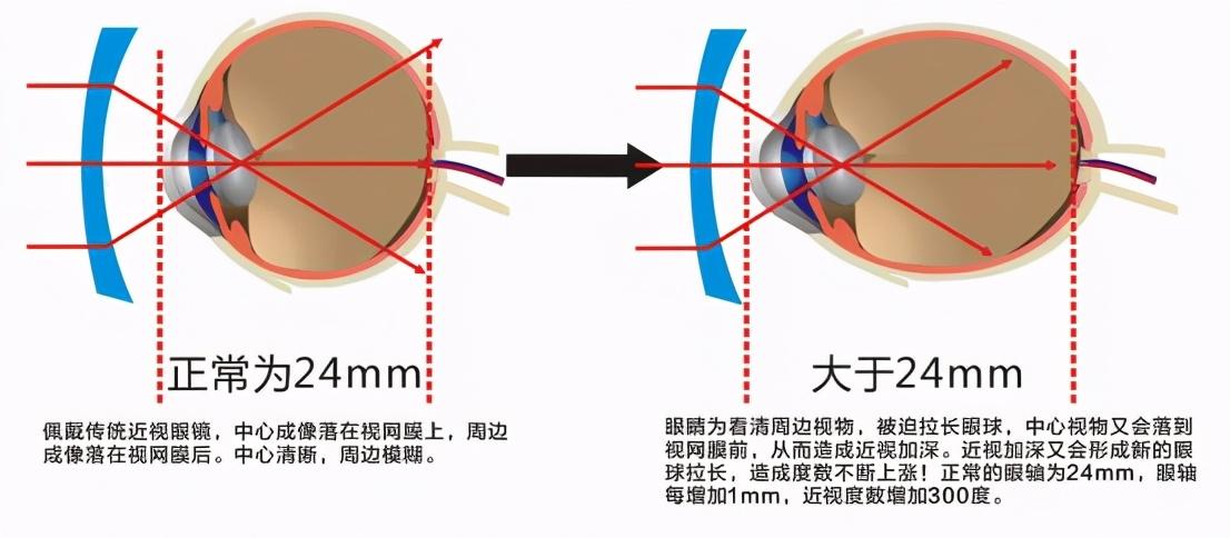 最新近视治疗科技，心灵与自然的治愈之旅