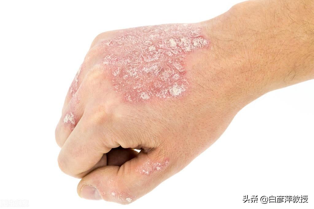 最新银屑病治疗方法，告别银屑病困扰的终极指南